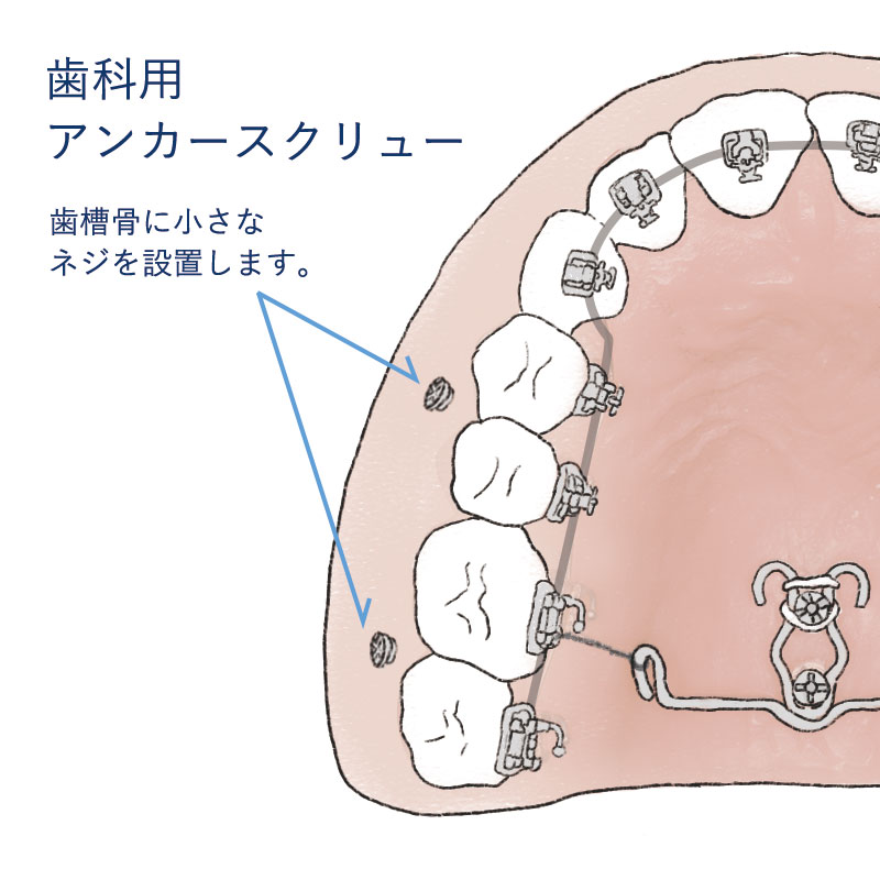 歯科用CTでアンカースクリュー設置箇所の確認