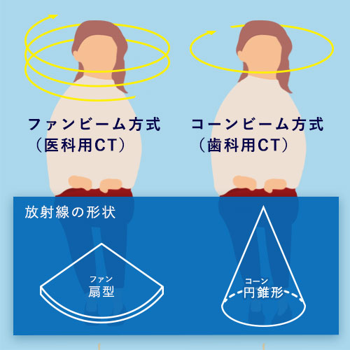 歯科用CTのコーンビーム方式