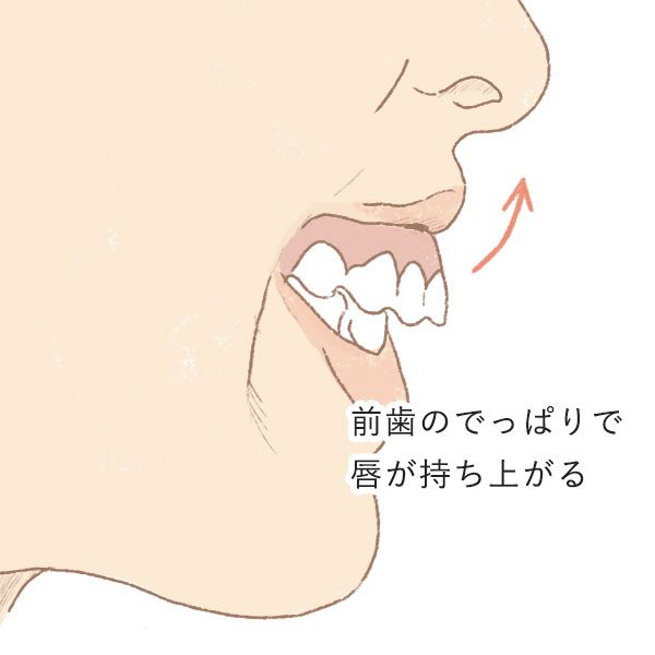 ガミースマイルの原因１