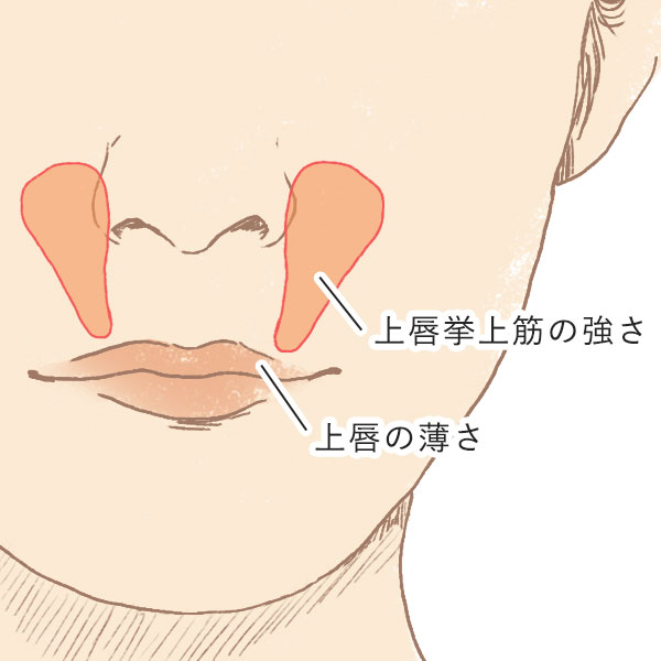 ガミースマイルの原因2