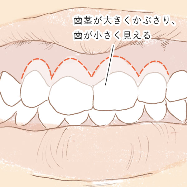 ガミースマイルの原因3