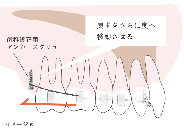 出っ歯・口ゴボで前歯を下げる