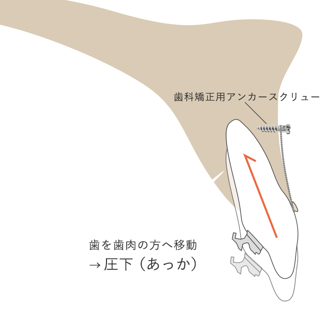 出っ歯・口ゴボで前歯を下げる