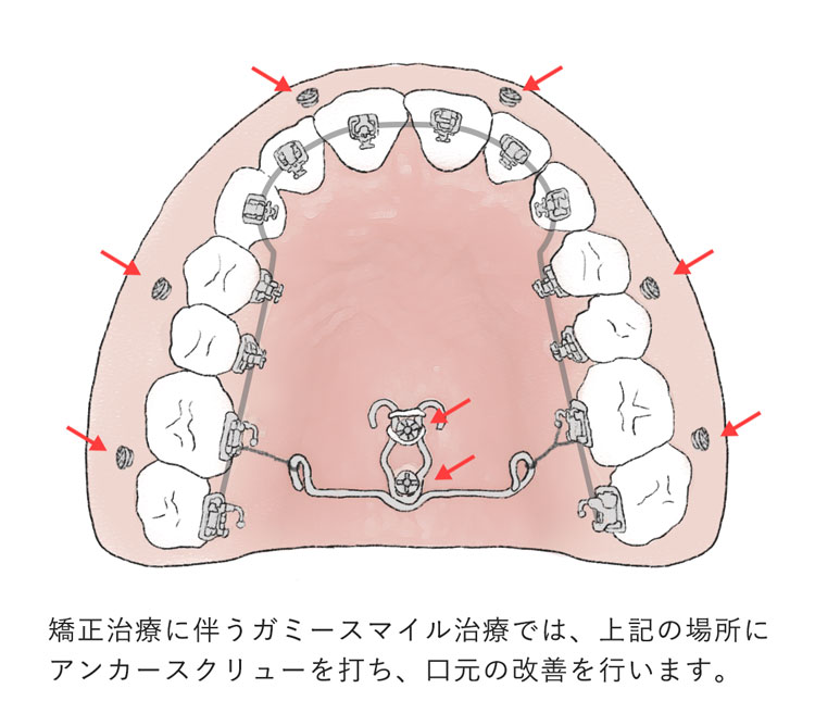 出っ歯・口ゴボで前歯を下げる