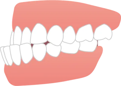 受け口のイラスト