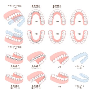 表側矯正　裏側矯正　マウスピース矯正　ワイヤー　渋谷　矯正歯科