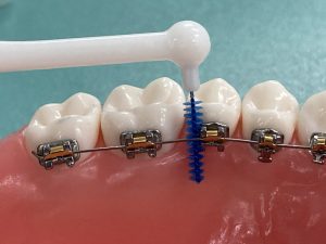 歯列矯正中の歯間ブラシの使い方