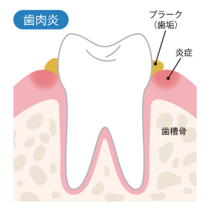 歯肉炎の図解イラスト