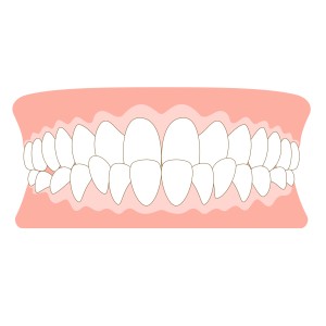 受け口の歯並びのイラスト