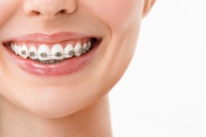 歯列矯正している女性の口元の写真