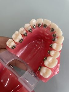 裏側矯正の歯の模型