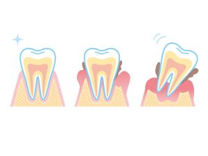 歯周病のイメージイラスト
