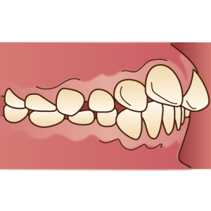 出っ歯　上顎前突　矯正