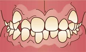 叢生　歯のでこぼこ　矯正