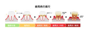 歯周炎の進行図