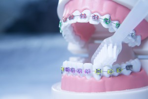 ワイヤー矯正の模型と歯ブラシ