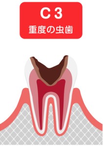 C3の虫歯のイラスト