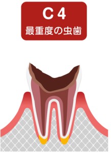 C4の虫歯のイラスト