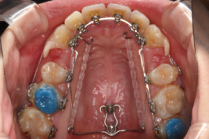 抜歯治療の症例写真