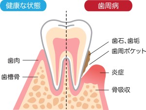 歯周病の解説イラスト
