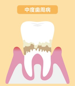 中度の歯周炎のイラスト