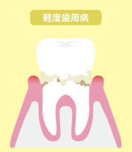 軽度の歯周炎のイラスト