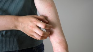 ストレスで腕に湿疹が出る女性