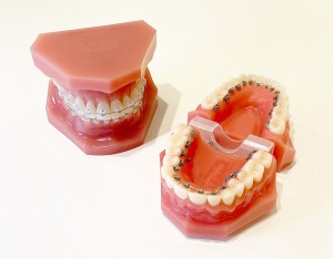 表側矯正と裏側矯正の歯の模型