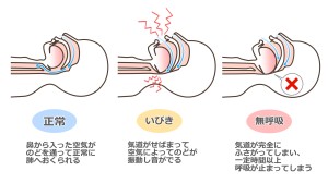 睡眠時の無呼吸やいびきの図解