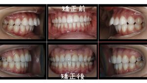 出っ歯の症例写真
