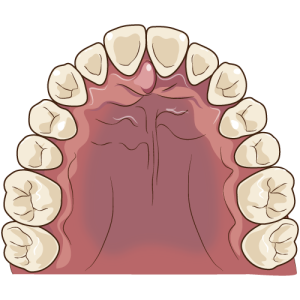 上顎の裏（スポット）のイラスト