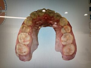 歯のスキャン画像4