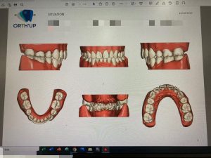 歯のスキャン画像（アフター）