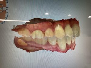 歯のスキャン画像1