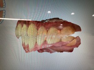 歯のスキャン画像3