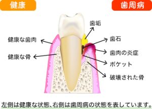 歯周病　歯肉炎　歯茎の炎症