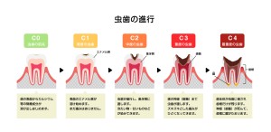 虫歯の進行　虫歯　歯周病