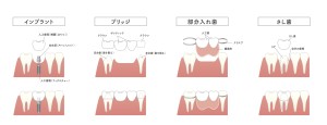 インプラント　ブリッジ　さし歯　入れ歯　部分入れ歯