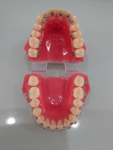 ハーフリンガル　歯科矯正　模型