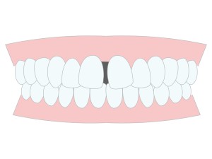 すきっ歯　正中離開
