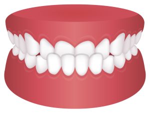 受け口　不正咬合　歯科矯正　裏側矯正