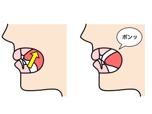 口腔筋機能療法