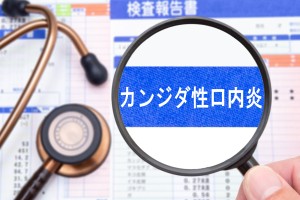 カンジダ性口内炎