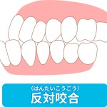 受け口　反対咬合　しゃくれ　渋谷矯正歯科