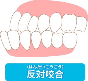 受け口　反対咬合　しゃくれ　渋谷矯正歯科