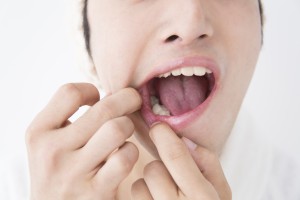 口内炎　矯正