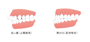 上下顎前突　渋谷矯正歯科
