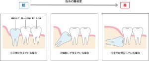 親知らず　生え方　渋谷矯正歯科