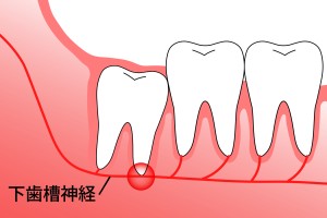 抜歯　リスク　渋谷矯正歯科