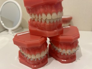 歯列矯正　装置の種類